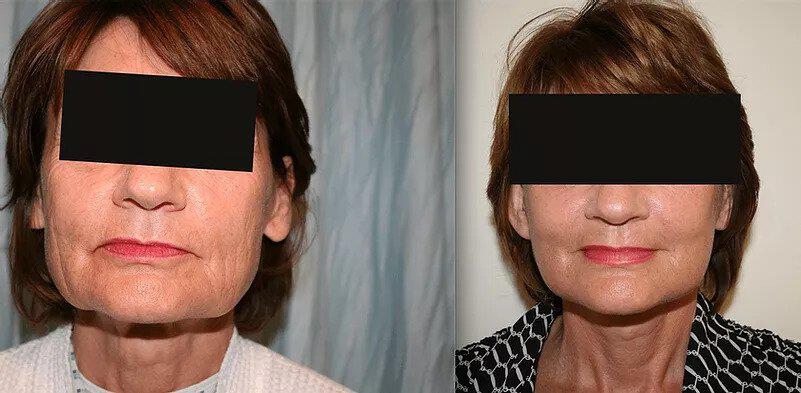 Facelift Before & After Image