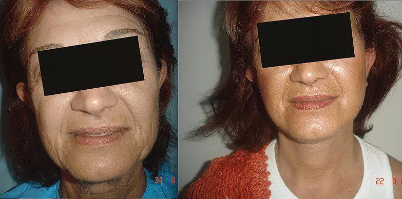 Facelift Before & After Image