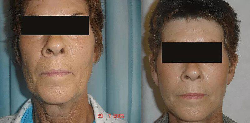 Facelift Before & After Image