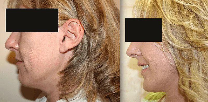 Facelift Before & After Image