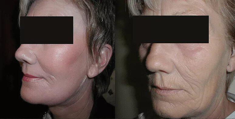 Facelift Before & After Image