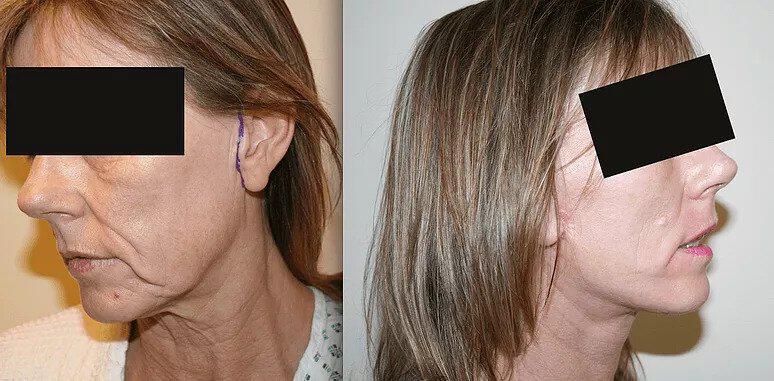 Facelift Before & After Image