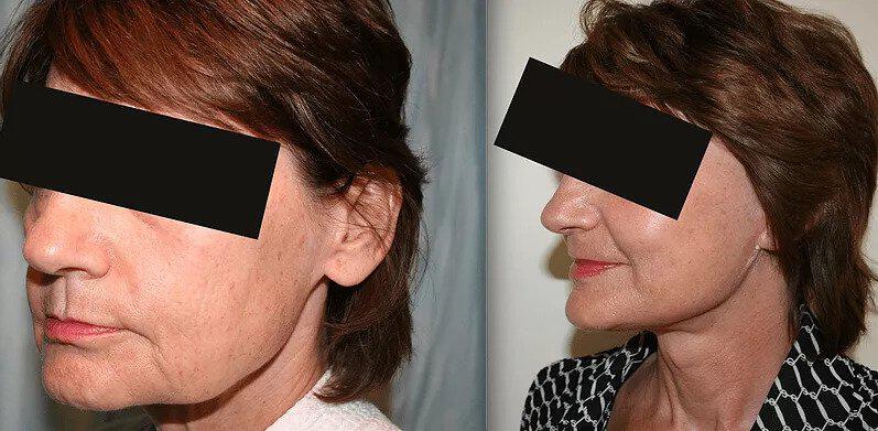 Facelift Before & After Image