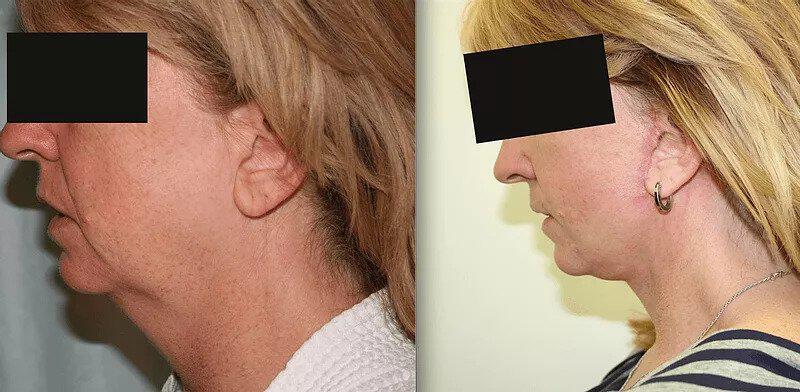 Facelift Before & After Image