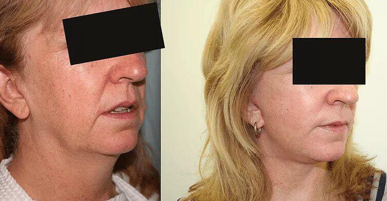 Facelift Before & After Image