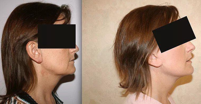 Facelift Before & After Image