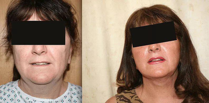 Facelift Before & After Image