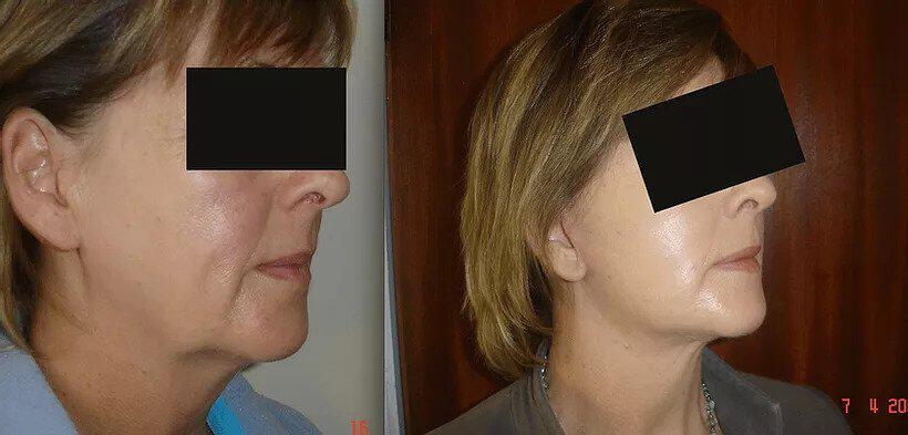 Facelift Before & After Image