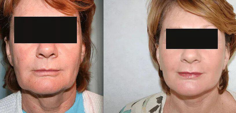 Facelift Before & After Image