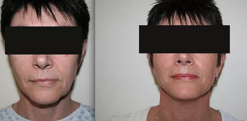 Facelift Before & After Image