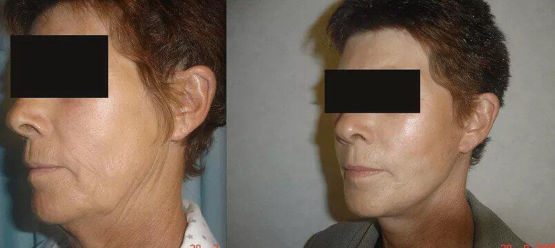 Facelift Before & After Image