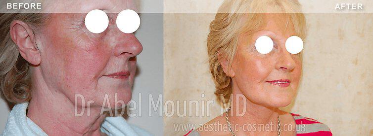 Facelift Before & After Image