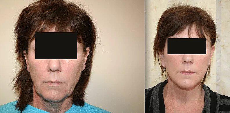 Facelift Before & After Image