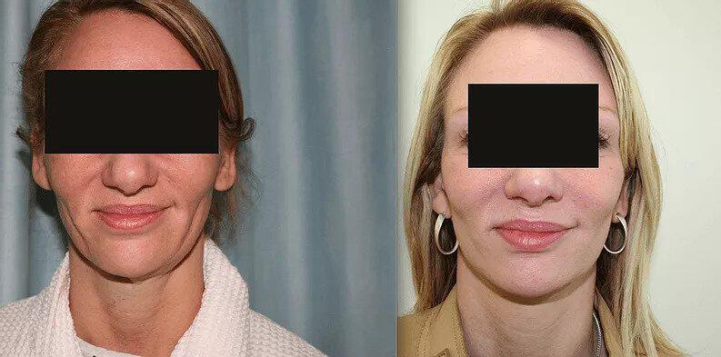 Facelift Before & After Image