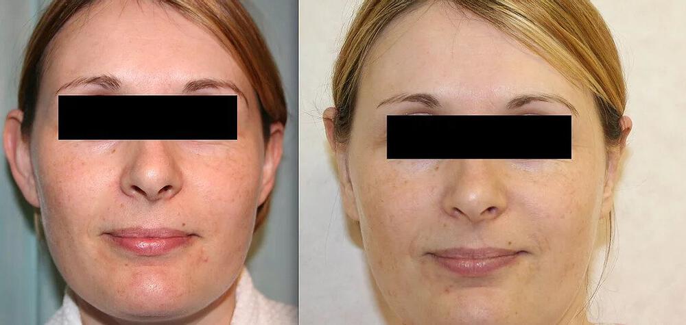 Otoplasty Before & After Image