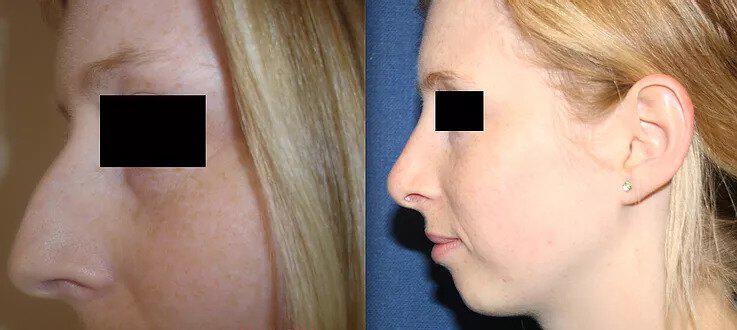 Rhinoplasty Before & After Image