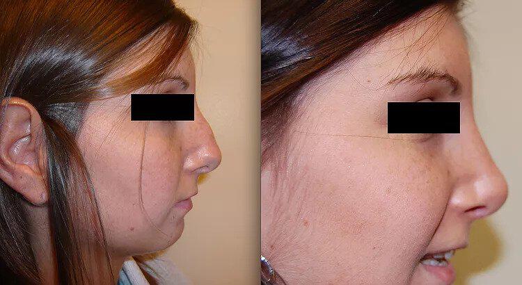 Rhinoplasty Before & After Image