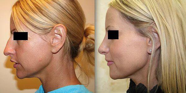 Rhinoplasty Before & After Image