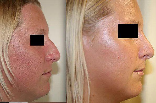 Rhinoplasty Before & After Image