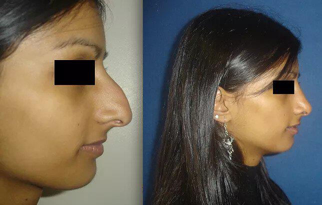 Rhinoplasty Before & After Image