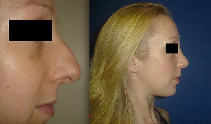 Rhinoplasty Before & After Image