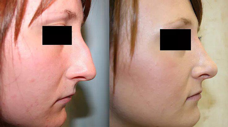 Rhinoplasty Before & After Image