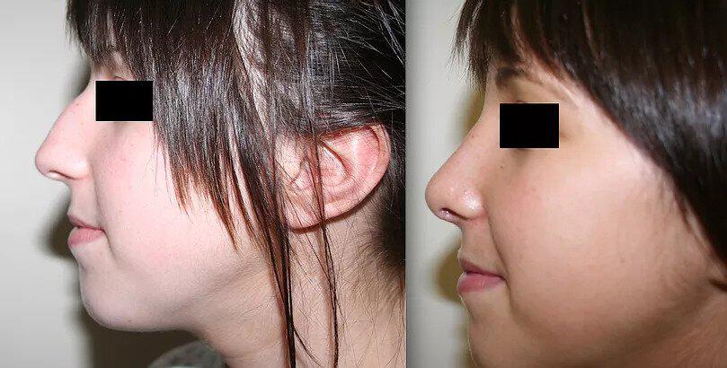 Rhinoplasty Before & After Image