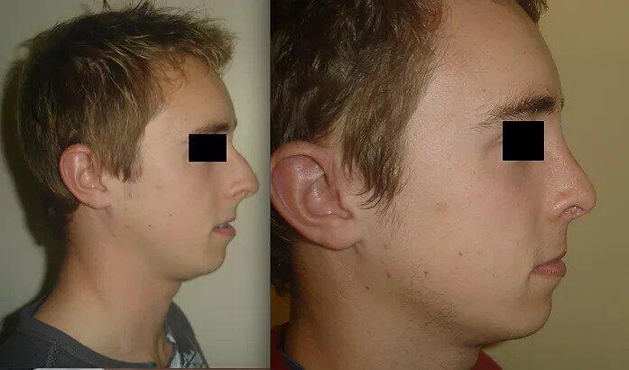 Rhinoplasty Before & After Image