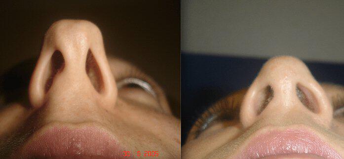 Rhinoplasty Before & After Image