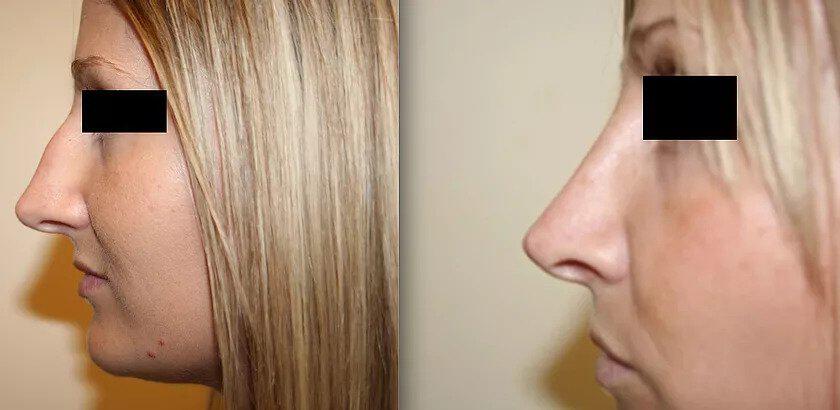 Rhinoplasty Before & After Image