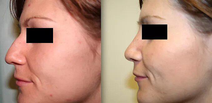 Rhinoplasty Before & After Image