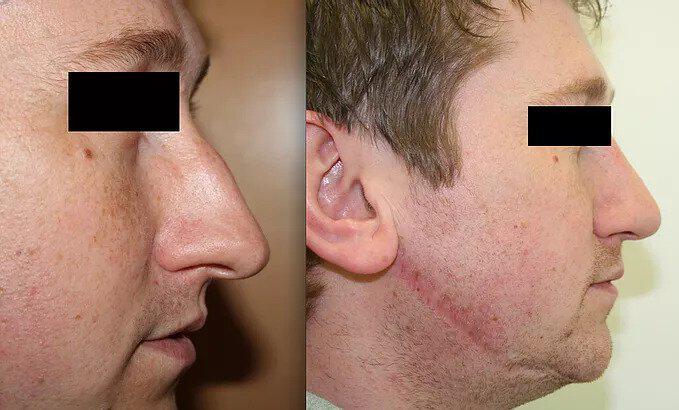 Rhinoplasty Before & After Image