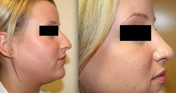Rhinoplasty Before & After Image