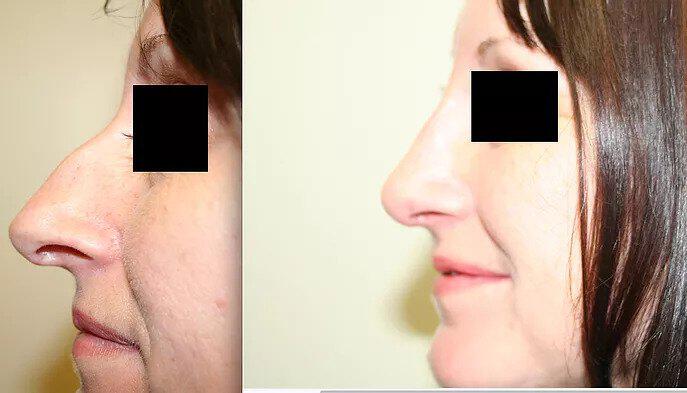 Rhinoplasty Before & After Image